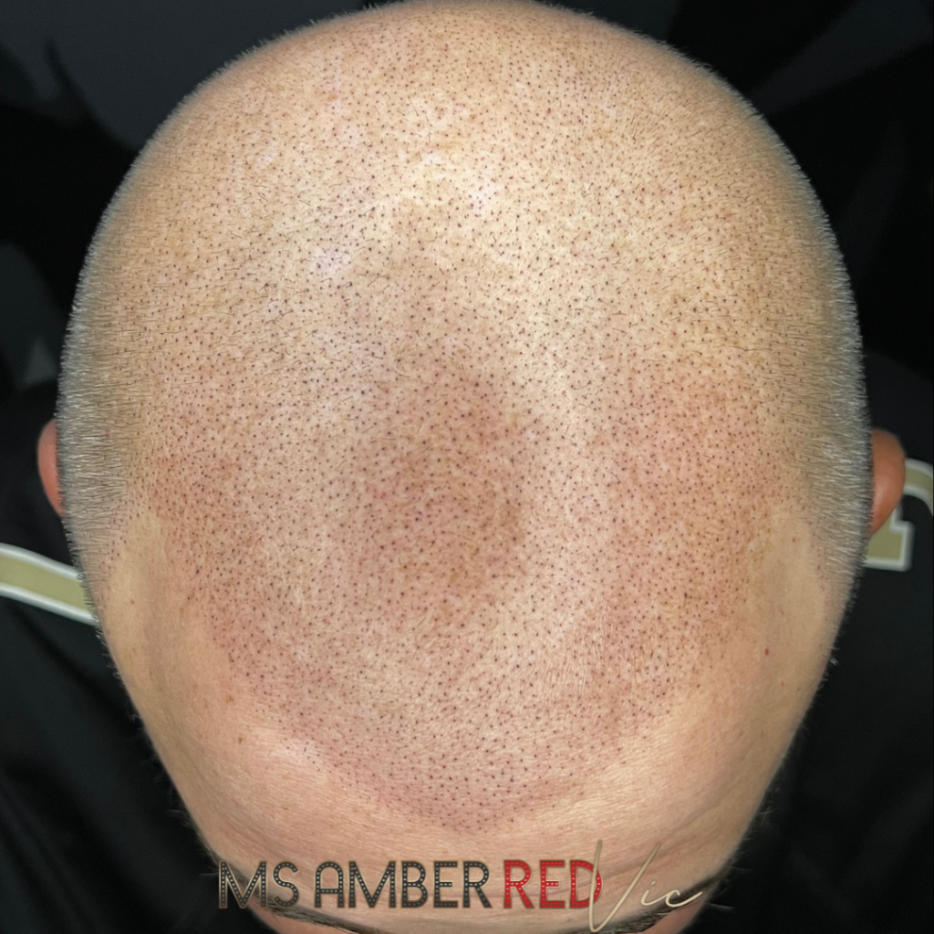 hair loss thinning hair hair transplant solution smp scalp micropigmentation msamberred las vegas