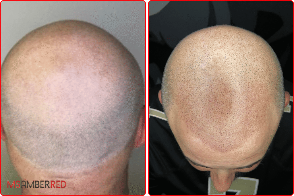 Scalp micropigmentation before and after for thinning hair in Las Vegas